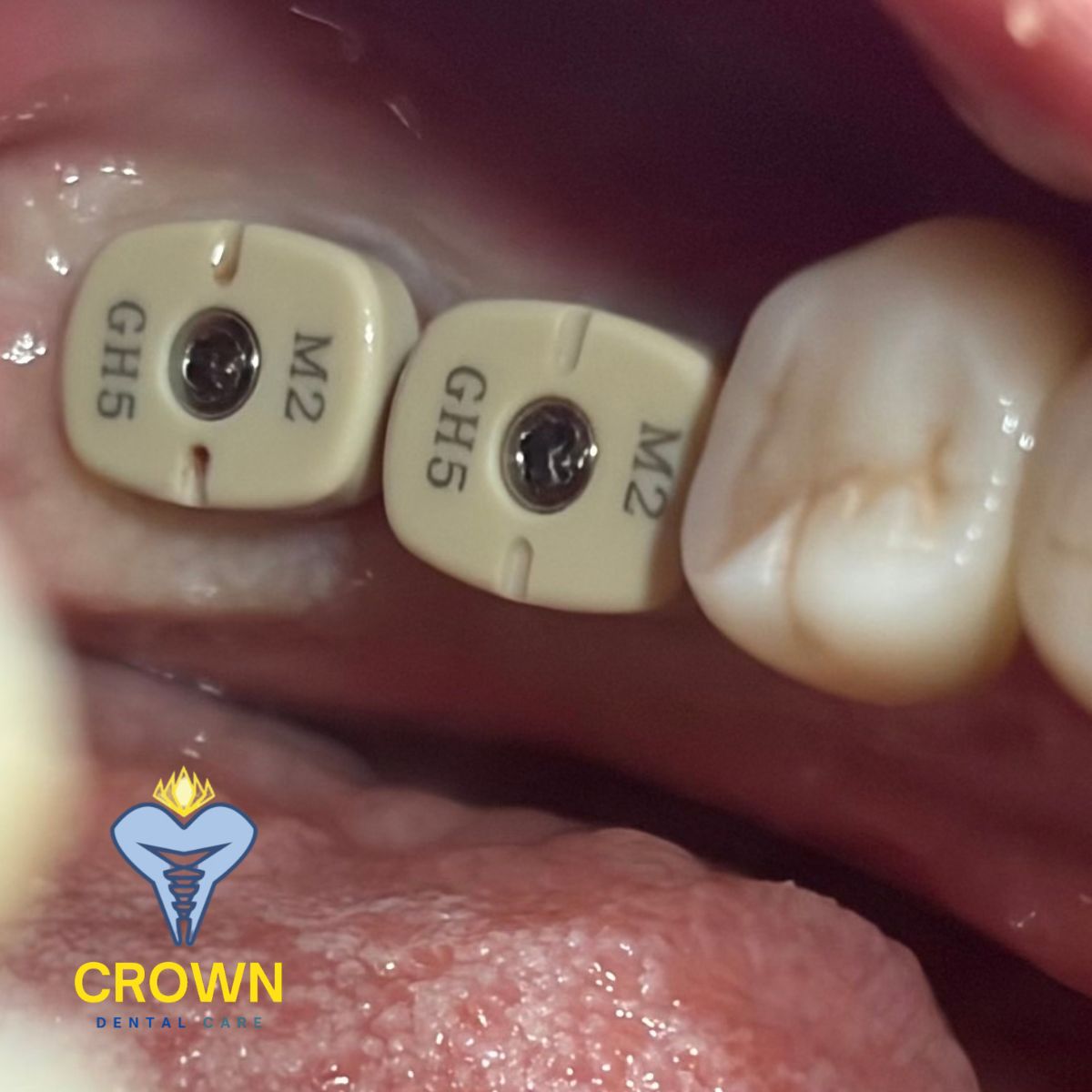 PMMA Anatomic Healing Abutment – Digital Implant Dentistry at Crown Dental Care Bengaluru
